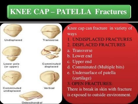 bronze kneecap|bruised knee cap symptoms.